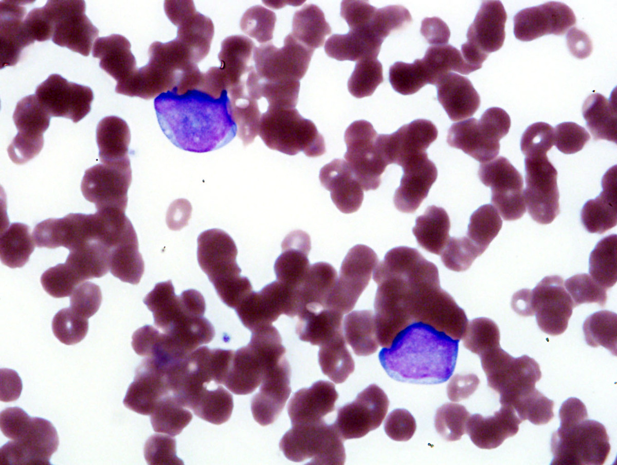 Fig. 2 8% blasts were noted in in the peripheral blood.